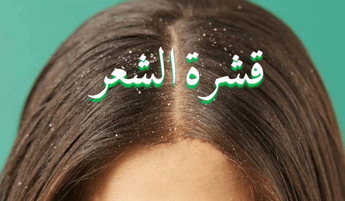 علاج قشرة الشعر بالأعشاب
